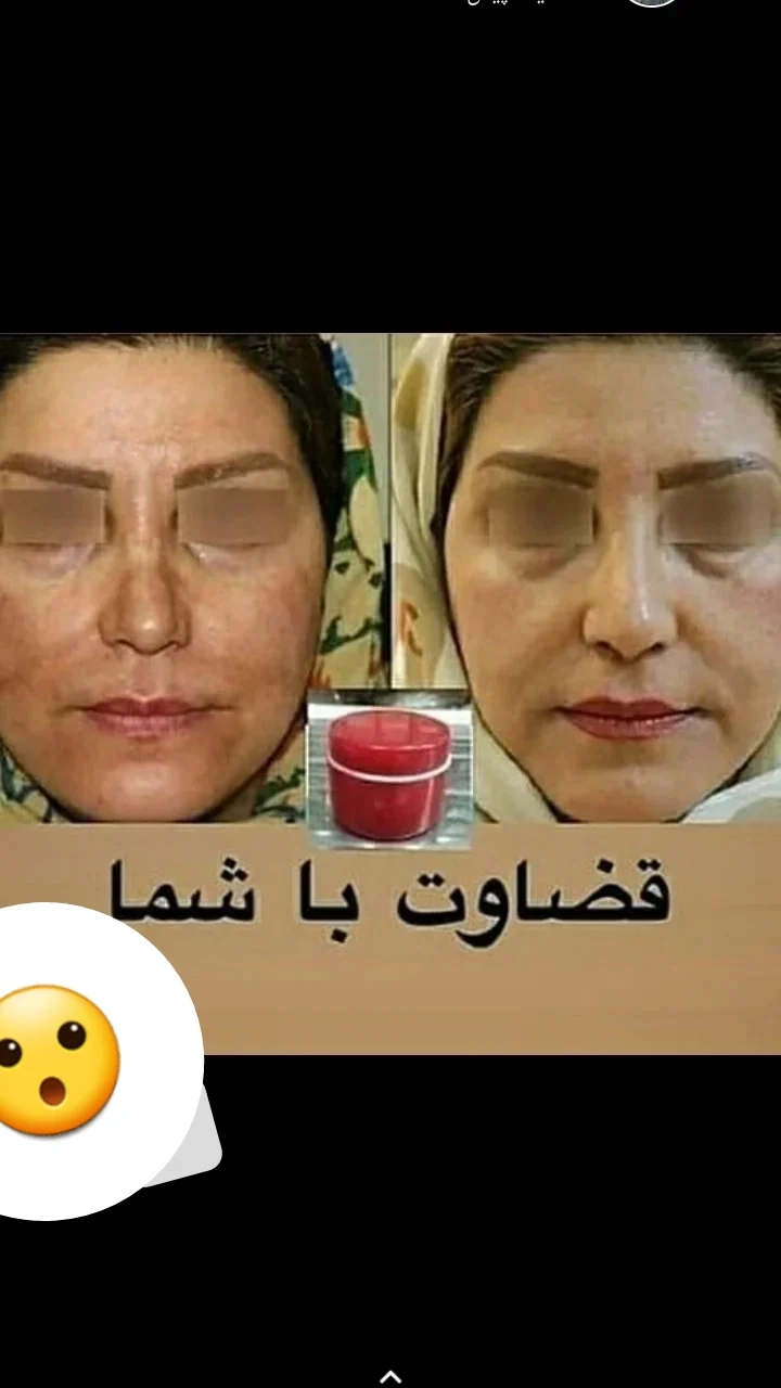 نتیجه استفاده از کرم معجزه أصل توسط مشتری عزیز